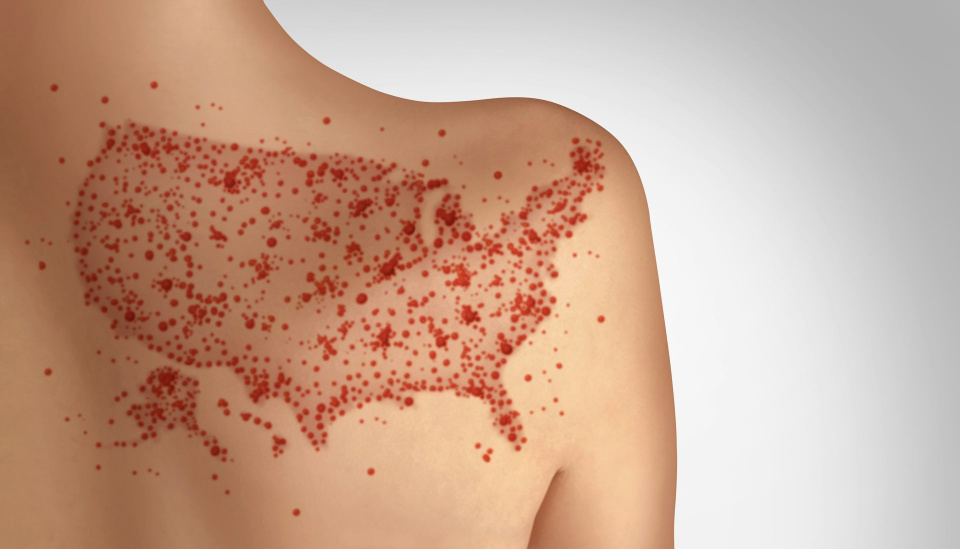 measles