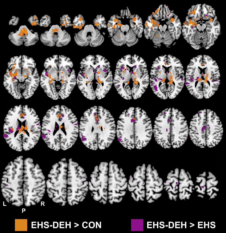 Dehydration Alters Human Brain Shape And Activity What 39 S Goin On Qatar