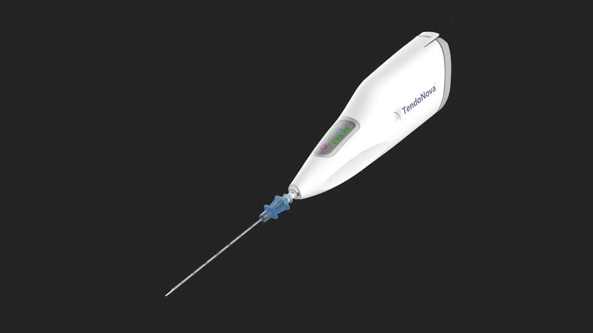 TendoNova's Ocelot device, a handheld tool to perform mechanical fragmentation and debridement of targeted tissues, a common procedure for athletes and others suffering from tendon pain disorders like tennis elbow, plantar fasciitis, and jumper’s knee. (Image Courtesy: TendoNova)