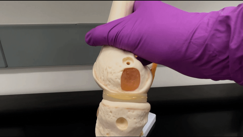 range of motion of implant for the knee being demonstrated in a short gif movie clip