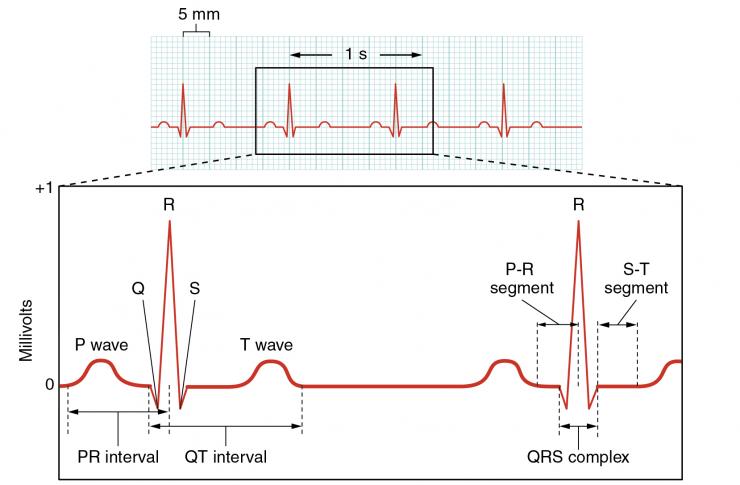 <p>An EKG (ECG) has clearly defined, repetitive waves and is a well-established diagnostic tool. Credit: Creative Commons, Anatomy &amp; Physiology, Connexions Web site. http://cnx.org/content/col11496/1.6 </p>