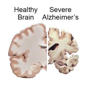 <p>The brain of an Alzheimer's sufferer in a severe stage can show extreme destruction of brain mass. Credit: National Institutes of Health</p>