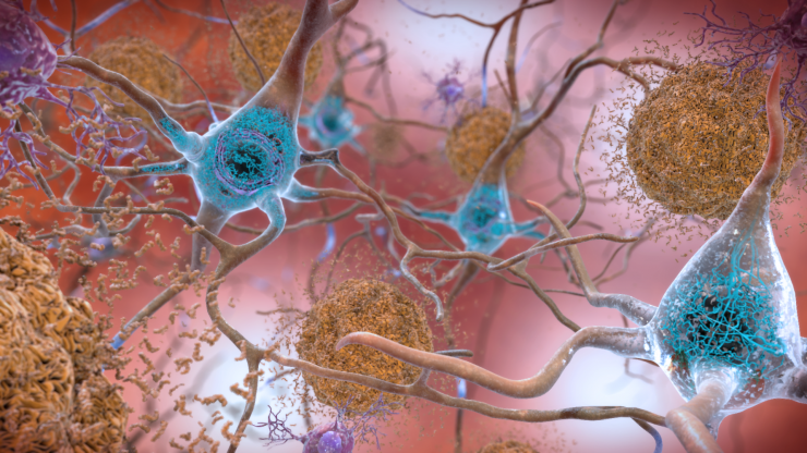<p>Artist's rendering of amyloid-beta plaque (beige clumps) outside of neurons and neurofibrillary tangles (blue) inside of neurons. Credit: National Institute on Aging, National Institutes of Health </p>