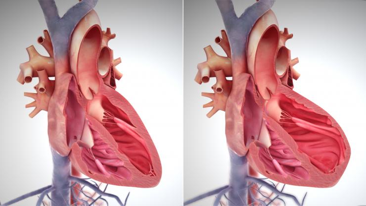 <p>On the left, a diagram of a healthy heart, on the right, a diagram of a heart in heart failure. The walls of the heart are thin, making its circulation of blood too weak. Credit: Creative Commons by Scientificanimations.com (Attribution-Share Alike 4.0 International)</p>
