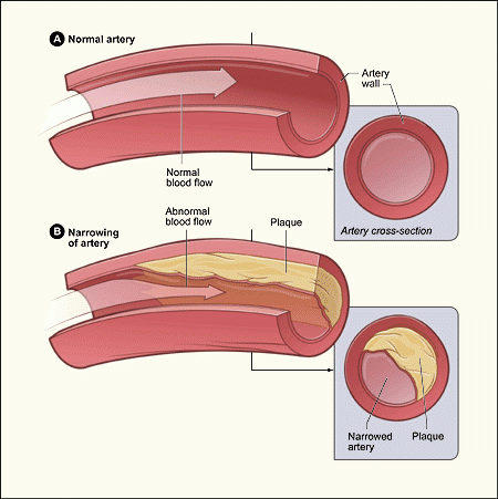 NIH National Heart, Lung, and Blood Institute atherosclerosis