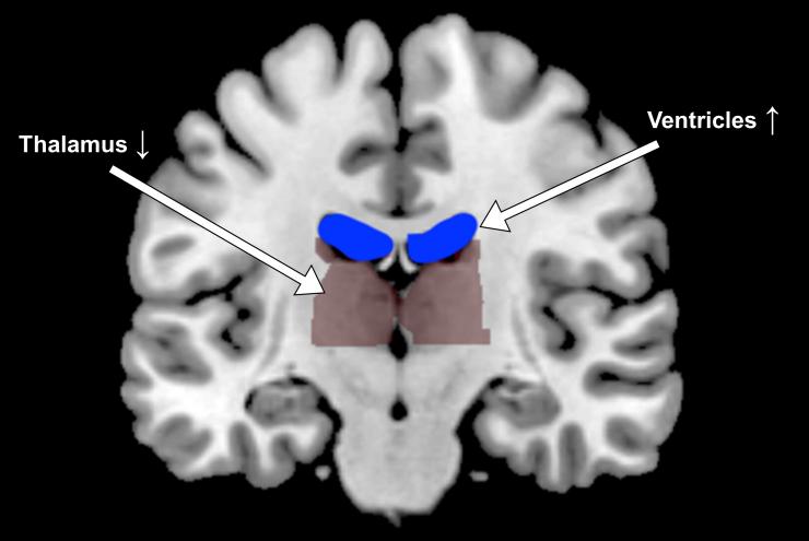<p>fMRI image of a test subject's brain reveals expanded ventricles and a more compact thalamus. Credit: Georgia Tech / Millard-Stafford / Wittbrodt</p>