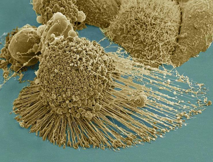 <p>A dying cancer cell with filopodia stretched out to its right. The protrusions help cancer migrate. Stock NIH NCMIR image. The image does not display a cell treated in the Georgia Tech study. Credit: NIH-funded image of HeLa cell / National Center for Microscopy and Imaging Research / Thomas Deerinck / Mark Ellisman. Use may require permission.</p>