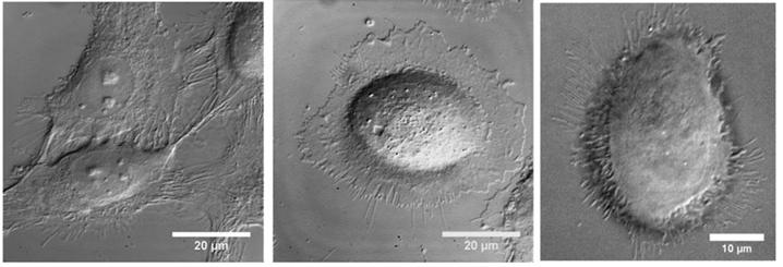 <p>From left to right: Untreated lab culture cancer cell, lab culture cancer cell with gold nanorods attached, lab culture cancer cell after addition of gentle NIR laser light. Credit: Georgia Tech / El-Sayed group</p>