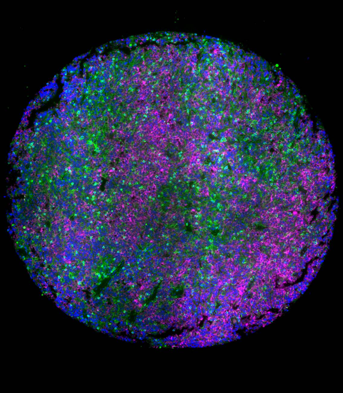 A colorful image of a lymph node tumor microenvironment of lymphoma. 