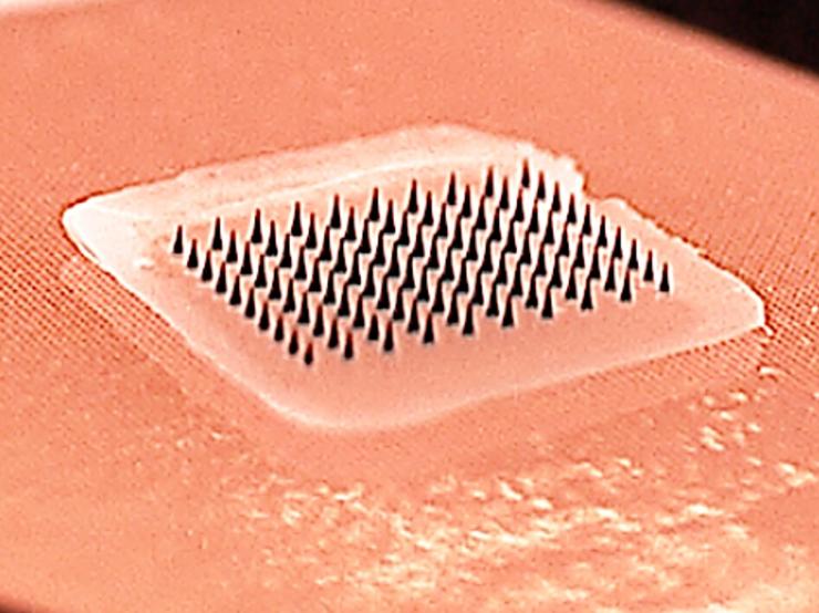 <p>This close-up image shows a microneedle array containing influenza vaccine. When pressed into the skin, the tiny needles dissolve, carrying vaccine into the skin. A majority of study participants said they would prefer to receive the influenza vaccine using patches rather than traditional hypodermic needles.</p>