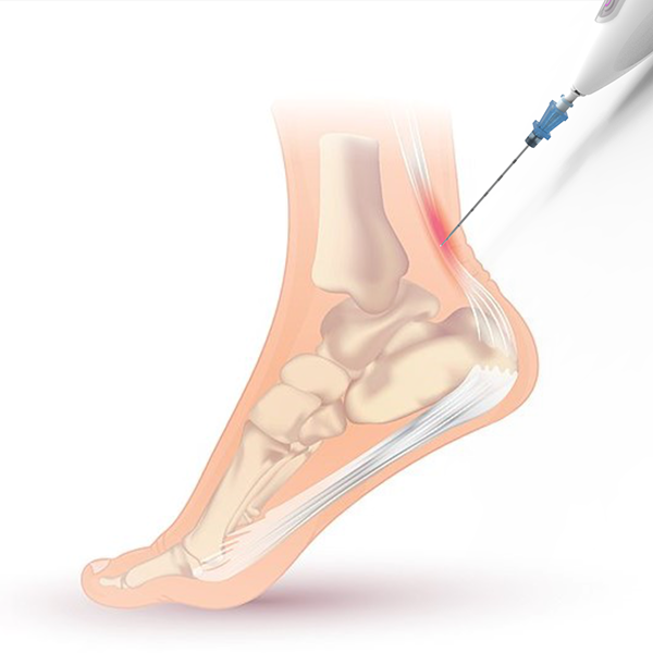 An illustration shows how the Ocelot device can be used to target the Achilles tendon in the heel during a mechanical fragmentation and debridement procedure to promote healing. (Image Courtesy: TendoNova)