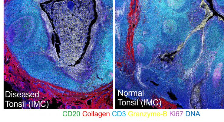 Multiplex bioimaging of human biopsy sample with 35 markers at a time. Distinct tissue architectures reveal the difference between health and disease in an immune tonsil organ. In this example, spatial distributions of different cell types and tissue structure were visualized by different colors: B-cells (CD20), Extracellular matrix (Collagen), T-cells (CD3), Cytotoxic protein (Granzyme-B), Cell proliferation (Ki67).
