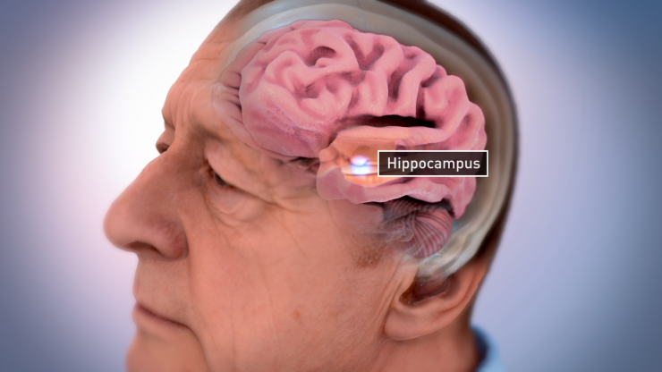 <p>The brain of an Alzheimer's sufferer can dramatically lose mass and shrink. In particular, center structures of the brain usually diminish early on. One such region susceptible to early and severe damage is the hippocampus, which can lead to memory loss and disorientation. Illustration credit: National Institute on Aging, National Institutes of Health</p>