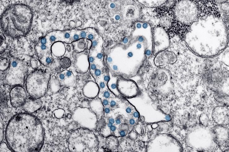 <p>Transmission electron microscopic image from the first U.S. case of COVID-19. The spherical viral particles, colorized blue, contain cross-section through the viral genome, seen as black dots. (Credit: Centers for Disease Control and Prevention)</p>