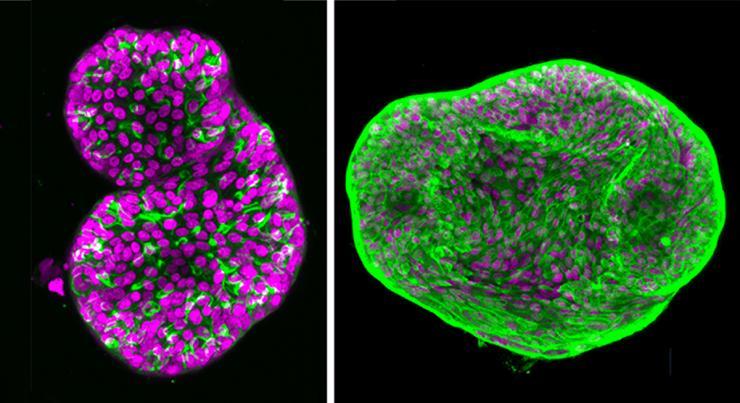 <p>Two organoids: The Matrigel-based model of prostate cancer is at left; the new, improved synthetic hydrogel model is at right.</p>