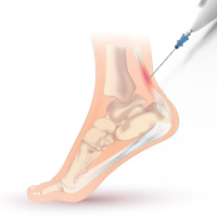 An illustration shows how the Ocelot device can be used to target the Achilles tendon in the heel during a mechanical fragmentation and debridement procedure to promote healing. (Image Courtesy: TendoNova)