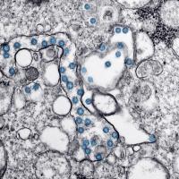 Transmission electron microscopic image from the first U.S. case of COVID-19. The spherical viral particles, colorized blue, contain cross-section through the viral genome, seen as black dots. (Credit: Centers for Disease Control and Prevention)
