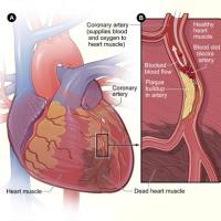 Coronary artery disease NIH