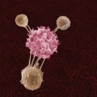 <p>Three T-cells attack a cancer cell in this artist's depiction.</p>

<p><em>Source: Getty Images / rights not transferable / not a press handout</em></p>