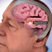 <p>The brain of an Alzheimer's sufferer can dramatically lose mass and shrink. In particular, center structures of the brain usually diminish early on. One such region susceptible to early and severe damage is the hippocampus, which can lead to memory loss and disorientation. Illustration credit: National Institute on Aging, National Institutes of Health</p>