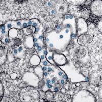 <p>Transmission electron microscopic image from the first U.S. case of COVID-19. The spherical viral particles, colorized blue, contain cross-section through the viral genome, seen as black dots. (Credit: Centers for Disease Control and Prevention)</p>