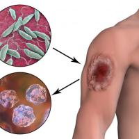 Leishmaniasis infector-disease illustration