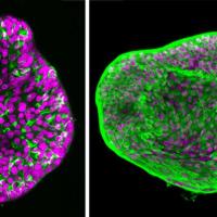 <p>Two organoids: The Matrigel-based model of prostate cancer is at left; the new, improved synthetic hydrogel model is at right.</p>