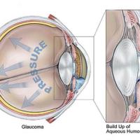 Glaucoma depiction BrightFocus Foundation